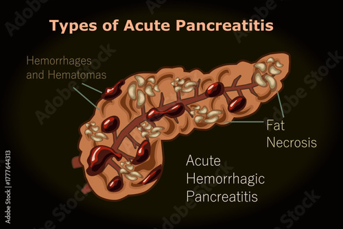 Types of Acute Pancreatitis, Hemorrhages and Hematomas, Fat Necrosis
