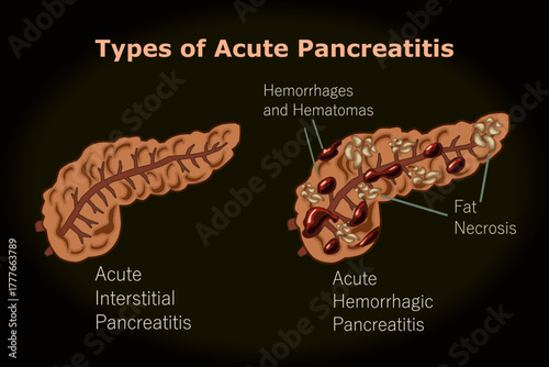 Types of Acute Pancreatitis, Hemorrhages and Hematomas, Fat Necrosis
