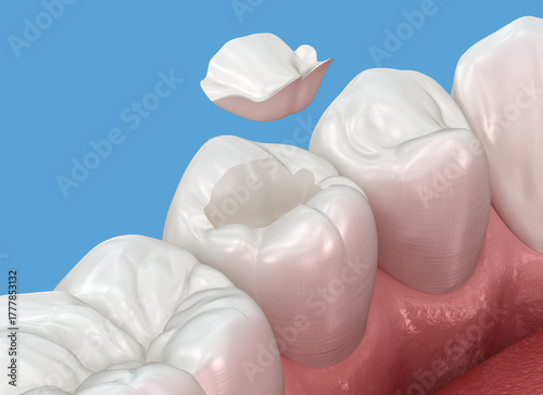 Inlay ceramic crown placement. Medically accurate 3D animation