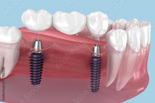Dental bridge based on two implants. Medically accurate 3D illustration of human teeth and dentures concept