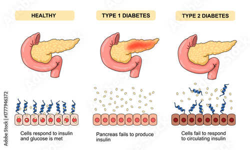 Types of diabetes. Insulin response in the body, pancreatic problems, resistant cells, increased blood glucose. Vector illustration for medical, biochemical, scientific, poster.