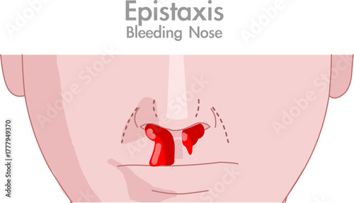 Epistaxis, bleeding from nose nosebleed drops blood flow. Human intelligence, medical draw. Vector illustration