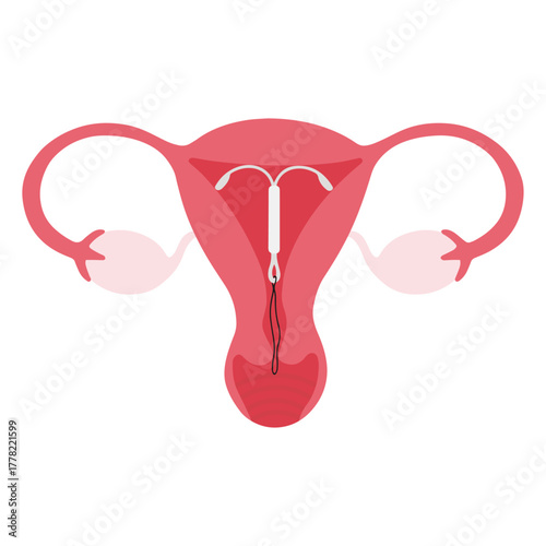 Uterus with iud inserted for contraception method