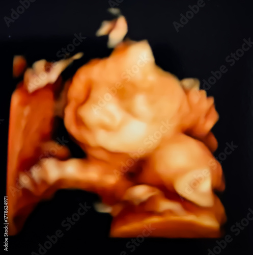 Collage of medical images of ultrasound anomaly scan on a male fetus 25 weeks into the pregnancy, inside womb. Anomaly scan usg.
