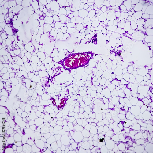 Lipoma, benign growth of fatty tissue, benign neoplasm, adipocytes, partially capsulated tumor, 40x microscopic view.