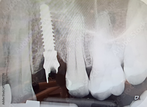 Loss of a dental implant. X-ray of a dental implant in the jawbone and a broken implant abutment. X-ray of the jaw and teeth at the dentist. Real photo. Dental concept.
