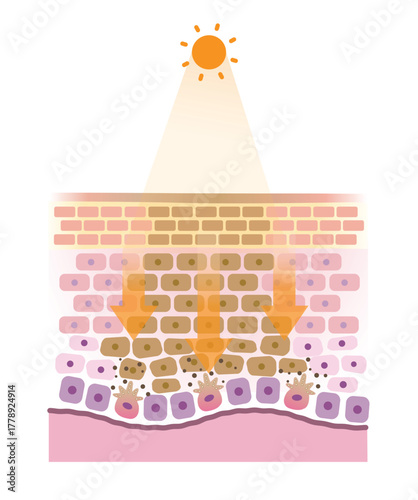 The mechanism of sunspots on skin layer vector illustration. Cross section of age spots when the skin is exposed to UV rays, the melanin is overproduced, collect into clumps and causing dark spots.