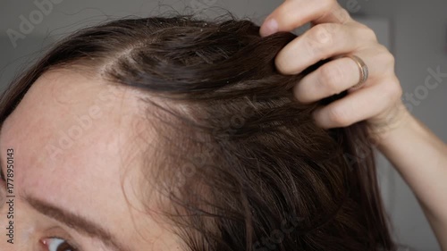 A hair growth stimulation procedure. A close-up of a woman applying a natural herbal remedy to her scalp. Anti-hair loss spray. A procedure for restoring hair growth in a patient.