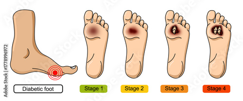 Diabetic foot syndrome stages. Foot wounds, deep ulcers, open wounds. Inflammation, infection, and amputation. Vector illustration for medical, diagnostic, and education.