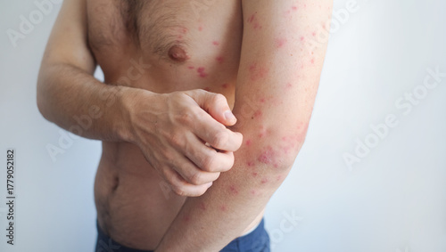Pink fine rash evenly covers a mans body showing mild viral symptoms with minimal inflammation and irritation.