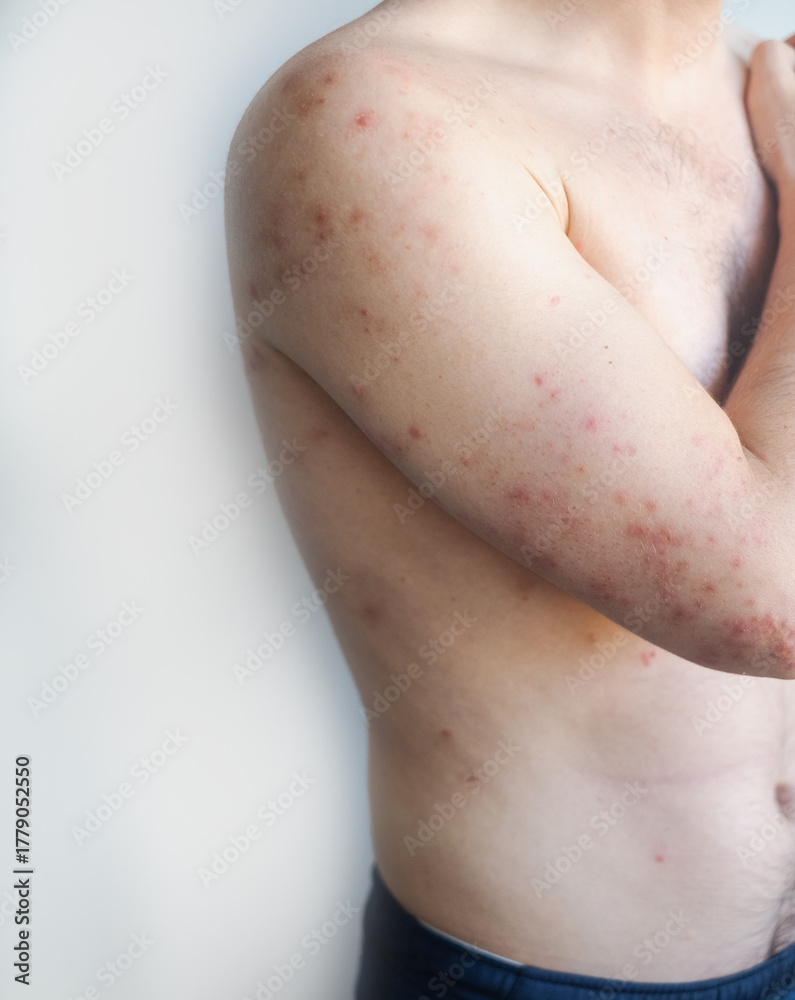 Fototapeta premium Man with pink fine rash over body experiencing mild itching and discomfort showing gentle viral skin infection in video.