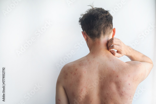 Red itchy spots and blisters on a mans body from insect bites showing severe skin irritation and inflammation in video.
