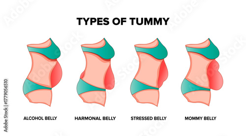 Diastasis Recti Illustration – Abdominal Muscle Separation After Childbirth
