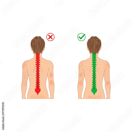 Illustration of human spine, comparing incorrect bad posture with proper good healthy alignment, anatomy education