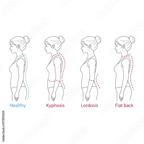 Human posture types, spinal column conditions, kyphosis, lordosis, flat back, healthy spine medical illustration