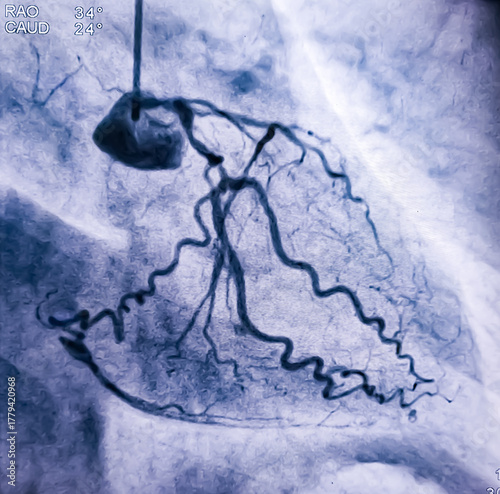 Photos Coronary angiogram of left coronary artery during cardiac catheterization with contrast dye
