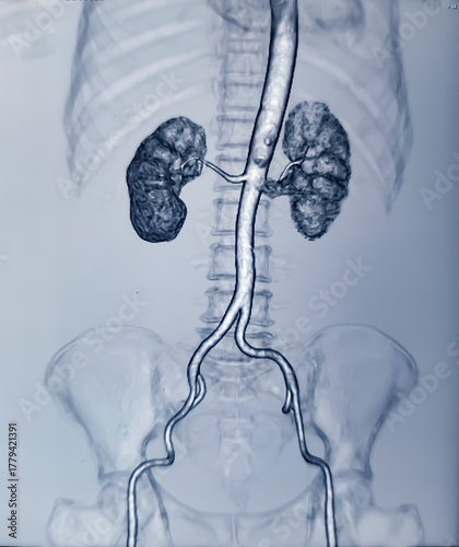 CT scan of KUB with contrast : Left renal small partially exophytic cortical cyst is seen at lower pole. Kidney cyst. Bilateral renal cortical simple cysts.