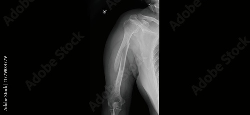 Shoulder X-ray radiograph showing humerus, scapula, clavicle, and glenohumeral joint anatomy. Medical diagnostic imaging for shoulder injury evaluation, fracture detection, and orthopedic assessment.