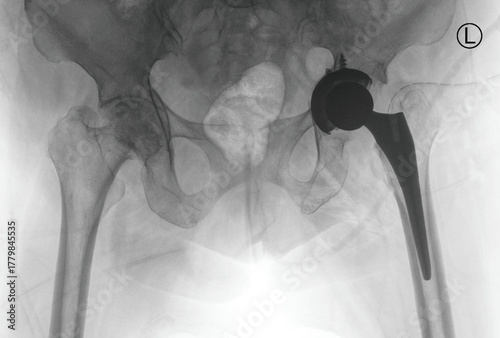Hip X-ray radiograph showing total hip replacement with prosthetic implant, femoral stem, and acetabular component in pelvis. Medical imaging for post-operative assessment and orthopedic joint.