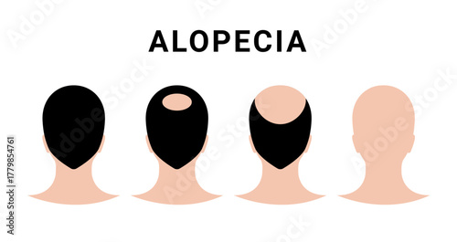 Hair alopecia head man. Bald vector head alopecia transplant hair male loss