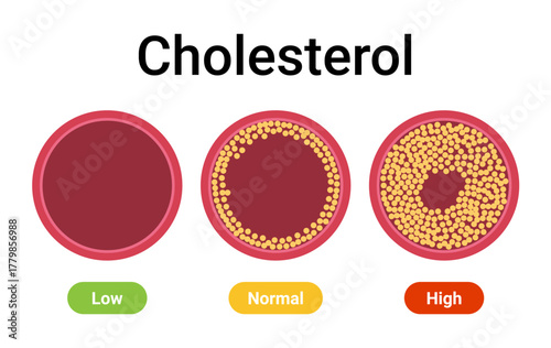 Cholesterol artery vessel blood atherosclerosis disease. Vascular human health arteriosclerosis artery illustration.