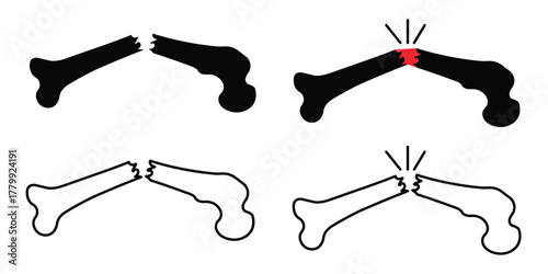 Medical bone fracture illustration set showing types of femur and hip breaks in vector style.