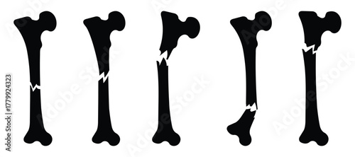 Detailed anatomy and types of bone fractures infographic for medical and healthcare design.
