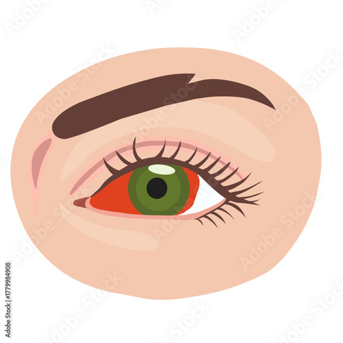 Red Eye Conjunctivitis or Severe Irritation Vector