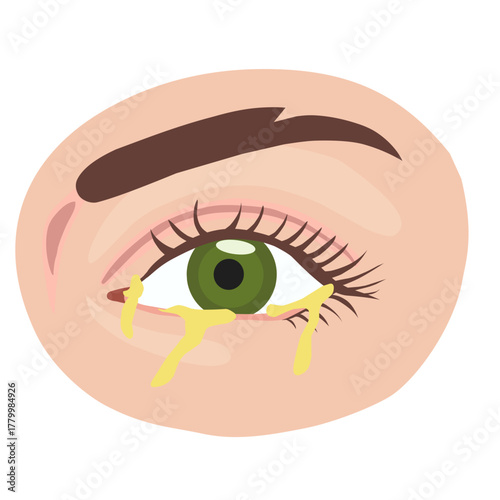 Infected Eye with Yellowish Discharge Vector