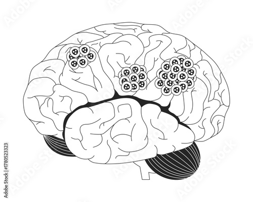 Human brain with cancerous tumors outline illustration. Cancer cells on cerebral organ. Malignant pathology. Oncology education 2D line object isolated on white. Monochrome vector ink linear image