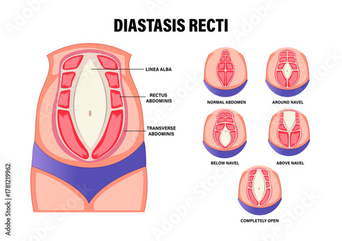 Diastasis Recti and Six-Pack Separation in the Abdominal Wall After Childbirth