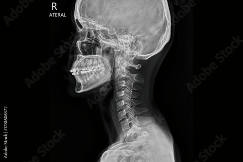 Lateral skull and cervical spine X-ray radiograph showing cranium, jaw with dental braces, neck vertebrae, and upper spine anatomy. Medical diagnostic imaging for orthodontic evaluation, skeletal.