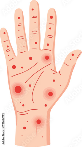 Flat illustration showing a human hand with widespread red rash spots, ideal for topics in dermatology, skin disease, infection, allergy, or symptom education