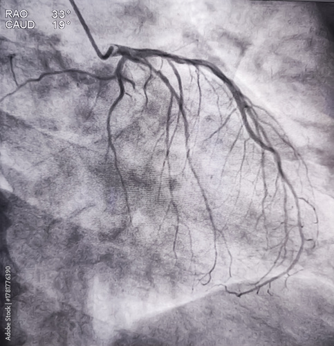 Coronary angiogram of left coronary artery during cardiac catheterization with contrast dye. Abnormal findings. Colour adjust