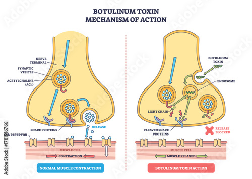 Botulinum toxin mechanism illustration shows a nerve terminal blocking acetylcholine release, key objects, synaptic vesicles, SNARE proteins, ACh receptor, transparent background.