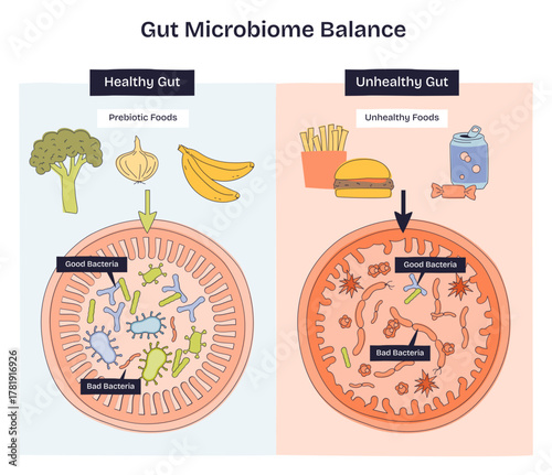 Gut microbiome balance shown as healthy vs unhealthy intestines, good and bad bacteria shift with prebiotic foods and junk food, key objects, intestine, bacteria, foods, transparent background.