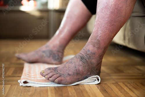 Billede på lærred The image showcases a close-up view of feet and ankles with visible edema, highlighting swelling, skin texture, and color variations against a textured wooden floor backdrop