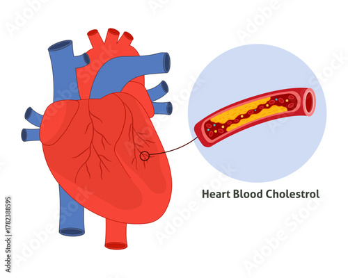 Clogged arteries caused by cholesterol Heart attack. Coronary artery disease