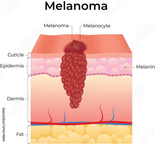 Melanoma Skin Cancer Anatomy Illustration