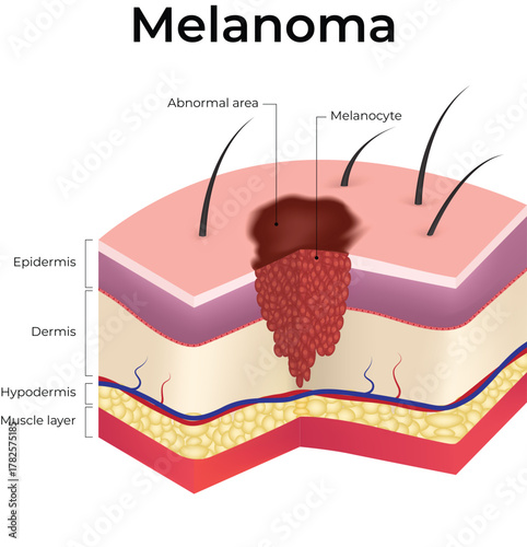 Melanoma Skin Cancer Progression Diagram