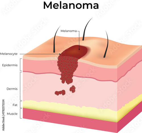 Melanoma Skin Cancer Cross-Section Diagram