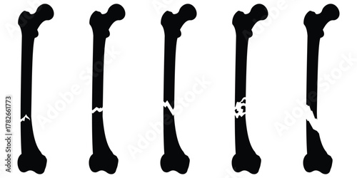 Broken Bone Icon Set – Medical Fracture Anatomy Symbols and Healthcare Vector 
Illustration