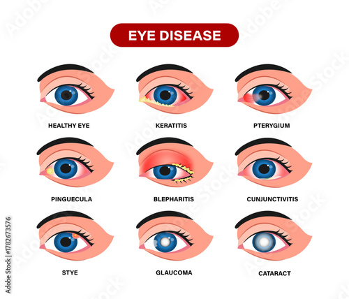 Surfer’s Eye (Pterygium) With Red and Irritated Pink Eye