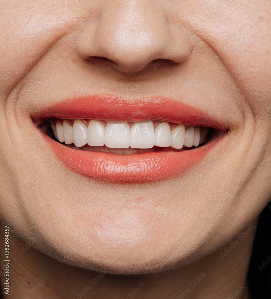 Obraz premium Closeup of straight white porcelain veneers with glossy coral lips