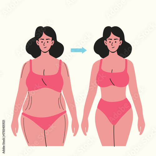 Plastic Surgery woman preparing for body contouring surgery to improve her figure