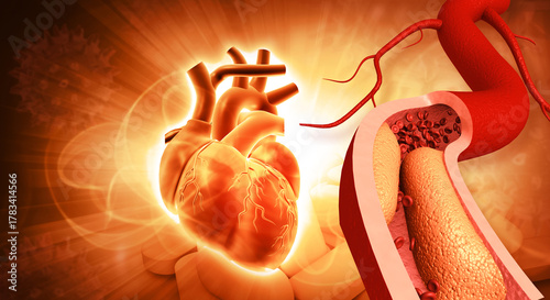 Tableau sur toile Human heart angioplasty, stent implantation. 3d illustration