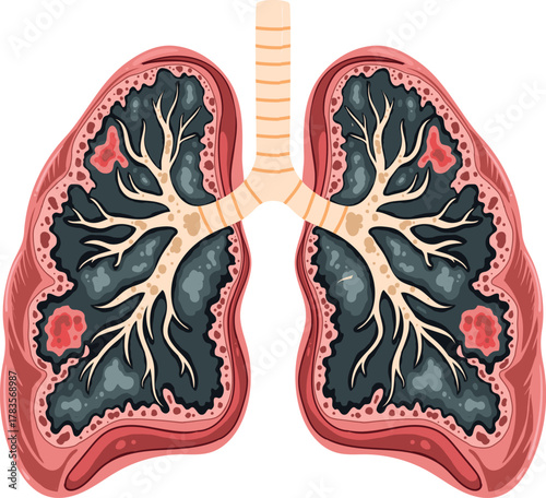 Unhealthy Human Lungs Medical Illustration