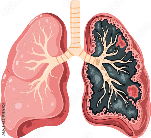 Healthy and Diseased Lungs Comparison Medical Info graphic