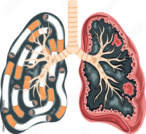 Smoking's Devastating Impact on Lungs