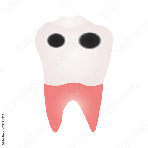 Tooth Decay Illustration